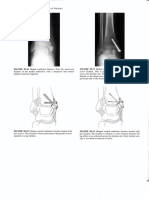 Treatment and Rehabilitation of Fractures (Stanley Hoppenfeld)