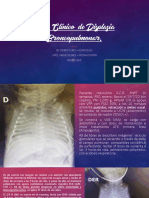 DBP - Casoclinico - CarolVargas Displasia Broncopulmonar.