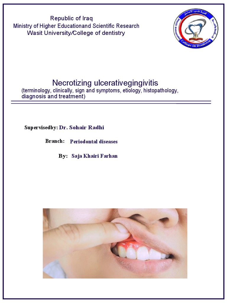 Necrotizing Ulcerative Gingivitis Overview | PDF | Periodontology ...