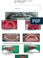 Case Reports 1 - (Rehabilitation of A Completely Edentulous Mouth by ALL ON 4 FIXED Prosthesis - A Case Report-1