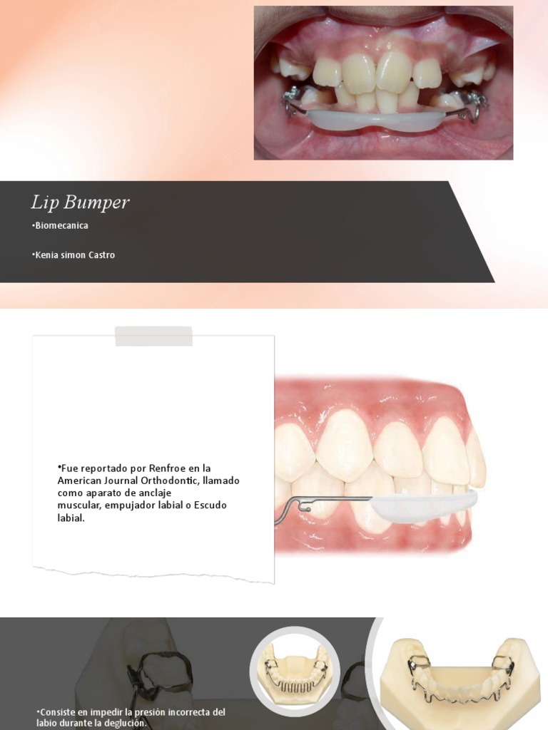 Lip Bumper y Quad Helix en Ortodoncia | PDF | Diente | Anatomia dental