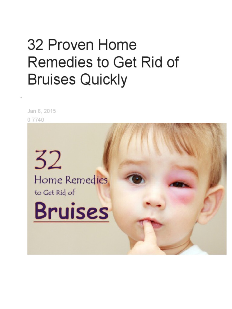 32 Proven Home Remedies To Get Rid of Bruises Quickly PDF Chocolate