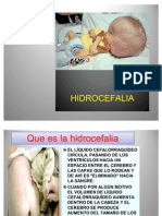 Hidrocefalia 1