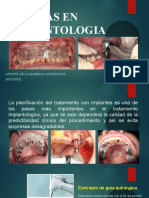 Ferulas en Implantologia