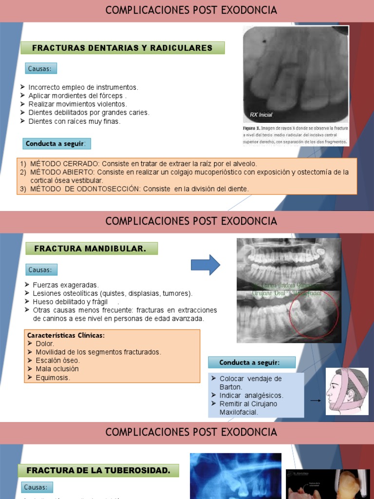 Exodoncia | PDF | Medicina CLINICA | Especialidades Medicas
