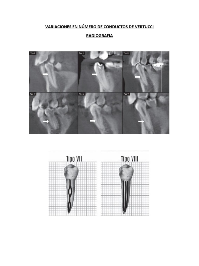Variaciones en Número de Conductos de Vertucci | PDF