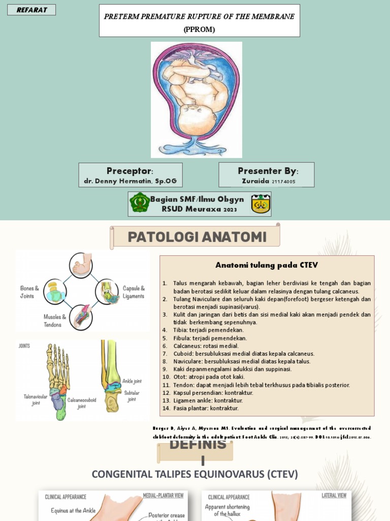 Salin 349643871 Congenital Talipes Equinovarus CTEV PDF