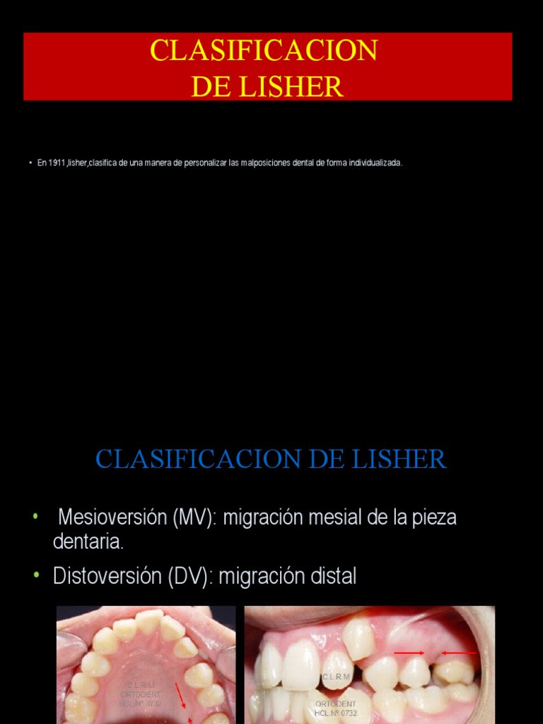 Clasificacion de Lisher | PDF