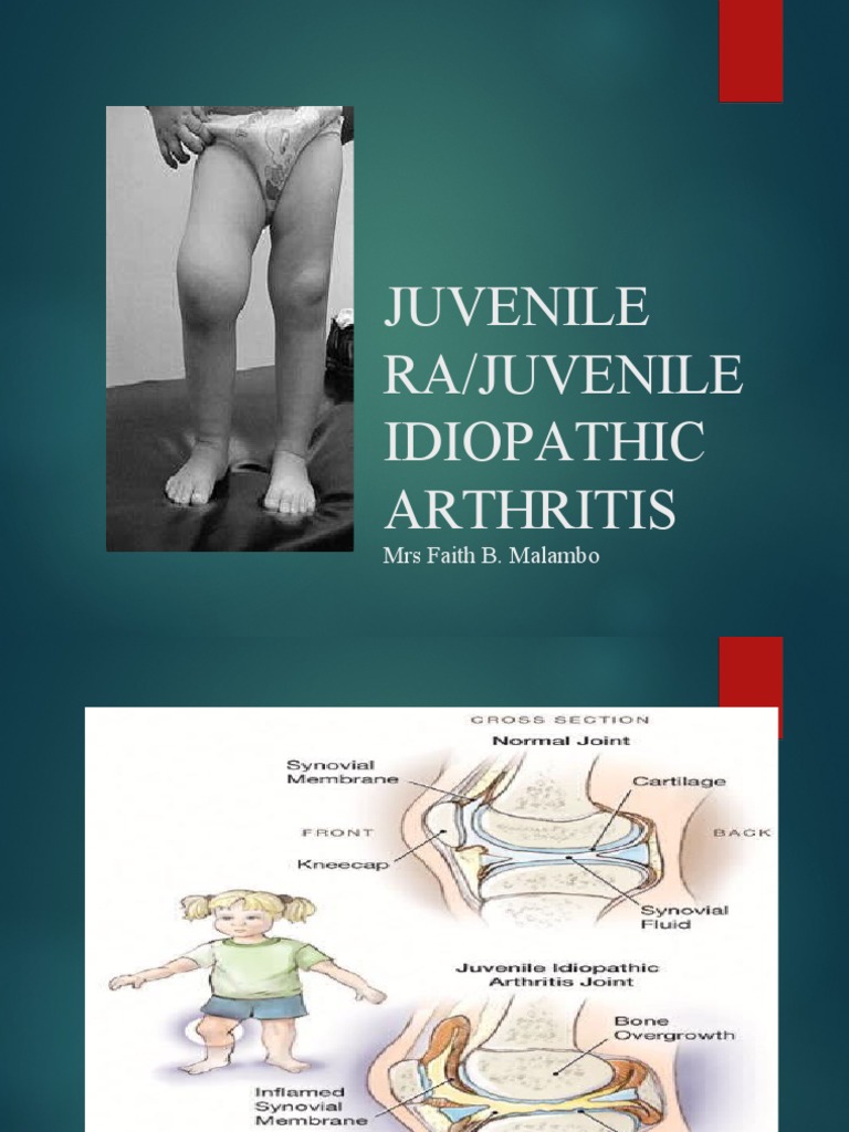 Juvenile Ra | PDF | Rheumatoid Arthritis | Arthritis