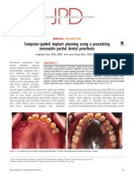 Computer-Guided Implant Planning Using A Preexisting Removable Partial Dental Prosthesis