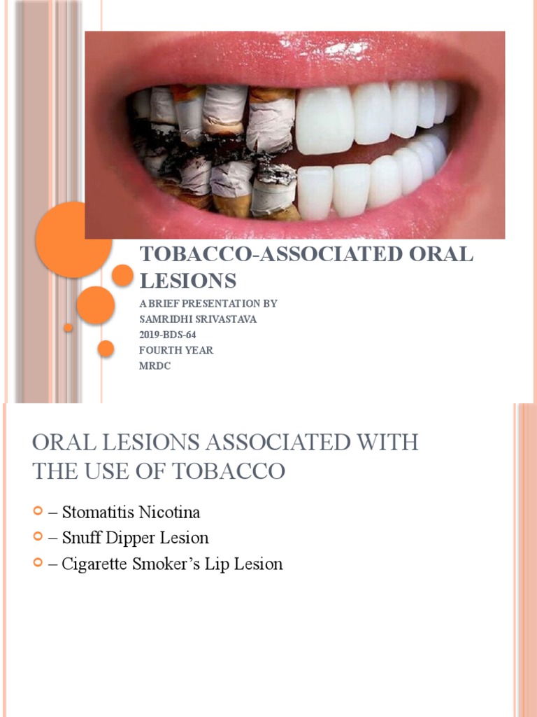 Tobacco-Related Oral Lesions Overview | PDF | Medical Specialties ...