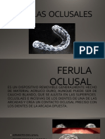 Ferulas Oclusales