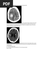 Download Pictures of CT Stroke by Kelvin Yuwanda SN62988897 doc pdf