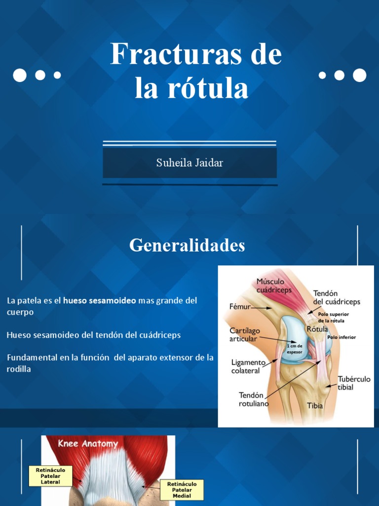 Fracturas de Rótula: Tipos y Tratamiento | PDF | Rodilla | Anatomía humana