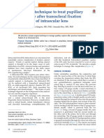 Simple Technique To Treat Pupillary Capture After Transscleral Fixation of Intraocular Lens