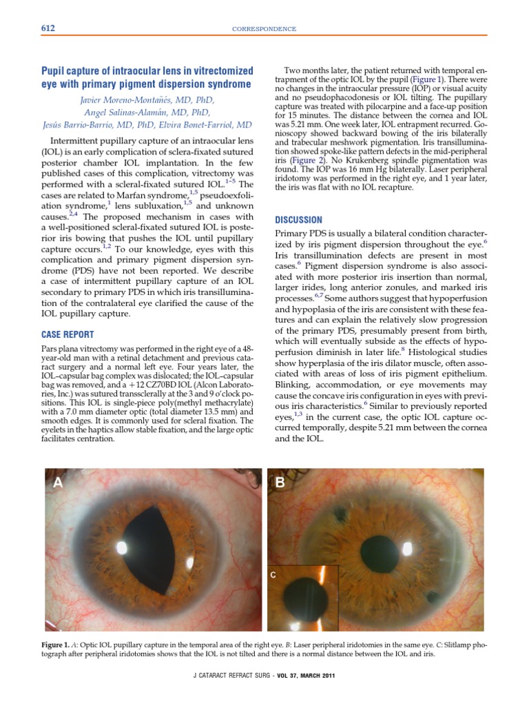 Pupil Capture of Intraocular Lens in Vitrectomized Eye With Primary ...