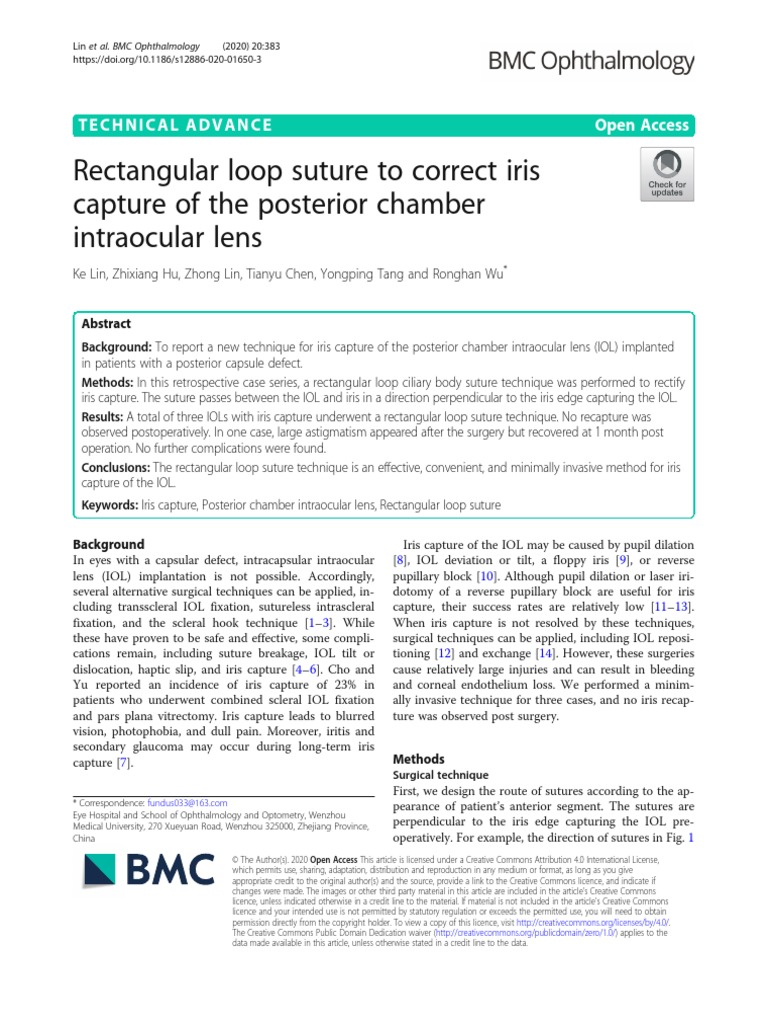 Rectangular Loop Suture To Correct Iris Capture of The Posterior