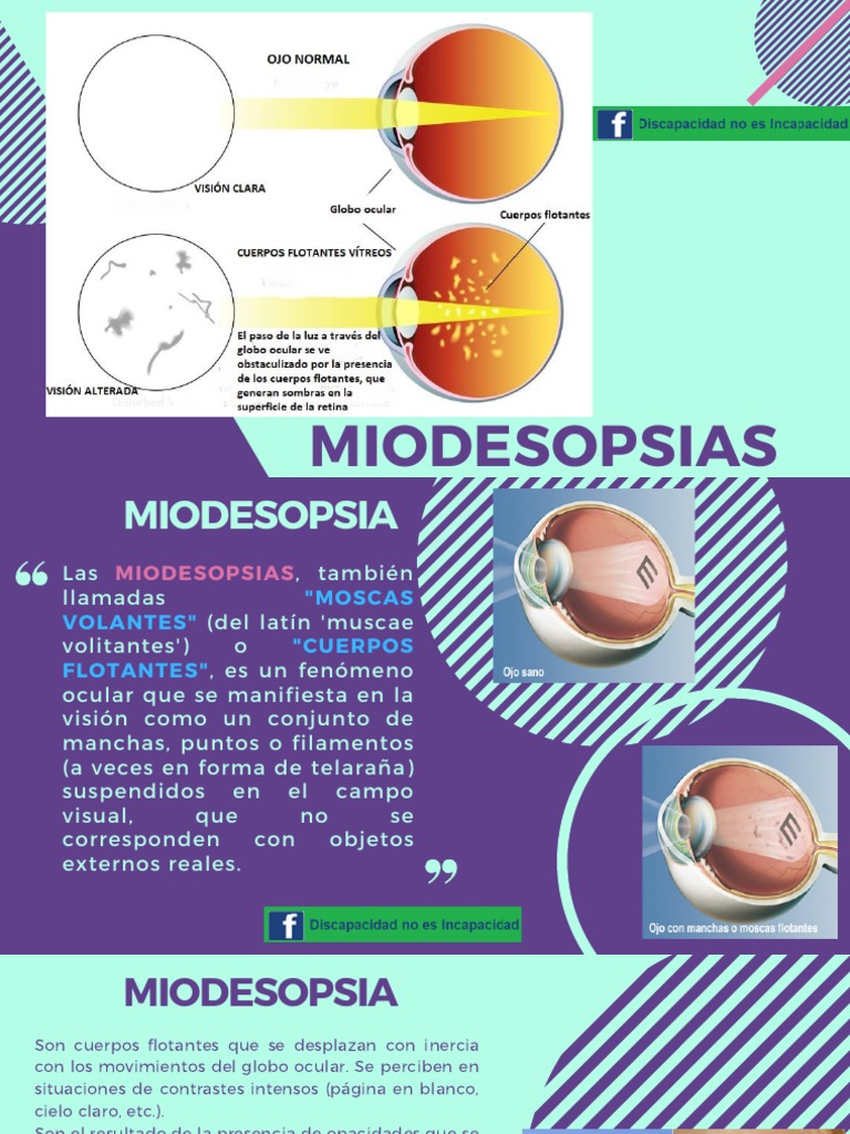 Miodesopsias - Cuerpos Flotantes | PDF | Visión | Enfermedades y trastornos