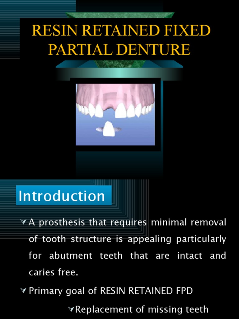 TYPES OF RESIN BONDED FIXED PARTIAL DENTURE intelligence overview