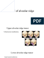 SCC of Alveolar Ridge