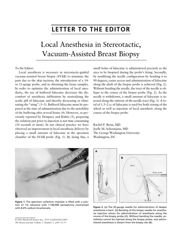 Local Anesthesia in Stereotactic, VacuumAssisted Breast Biopsy PDF
