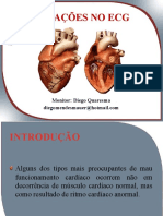 Alterações no ECG: Taquicardia, Fibrilação e Bloqueios