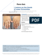 White Lesions On The Hands and Lower Extremities