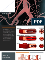 Aneurisma