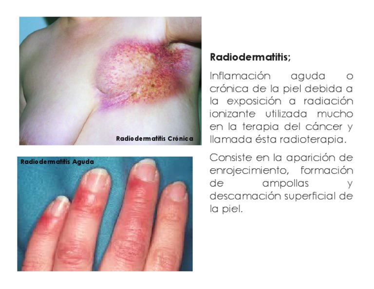 radiodermatitis-pdf