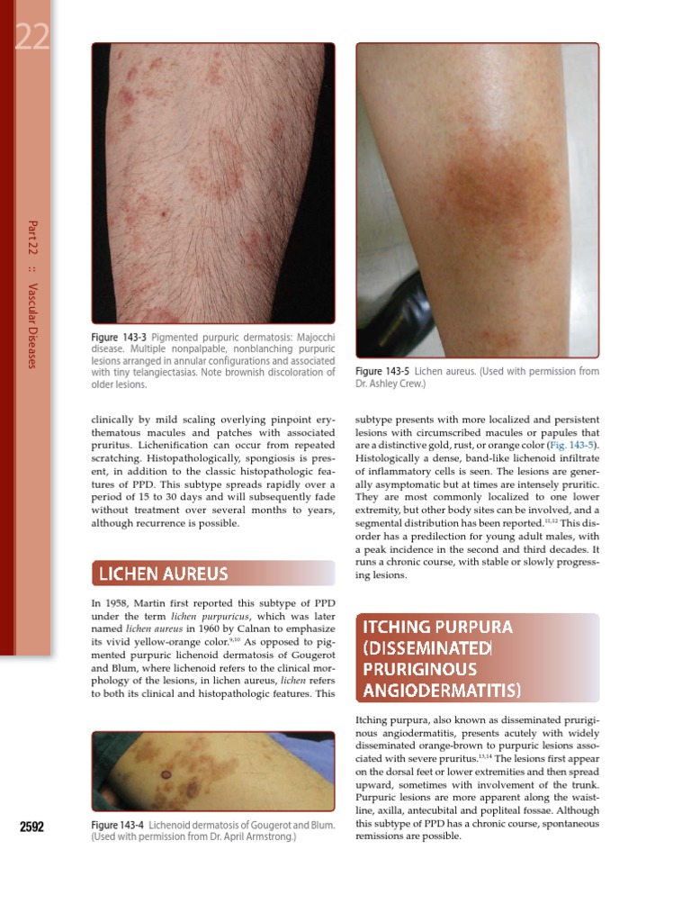Lichen Aureus PDF Anatomy Cutaneous Conditions