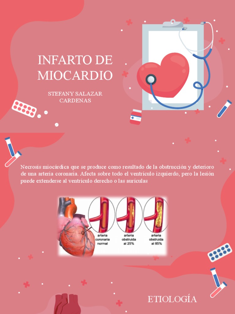 Infarto de Miocardio: Causas y Tratamiento | PDF | Infarto de miocardio ...