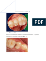 Caries Primaria Es La Caries Que Se Presenta Por Primera Vez en Un Diente.