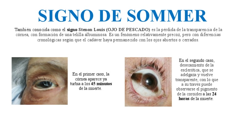Signo de Sommer: También Conocida Como El Signo | PDF