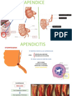 Apendicitis Aguda 