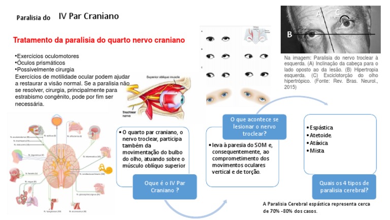 infografico-paralisia-do-iv-par-craniano-pdf