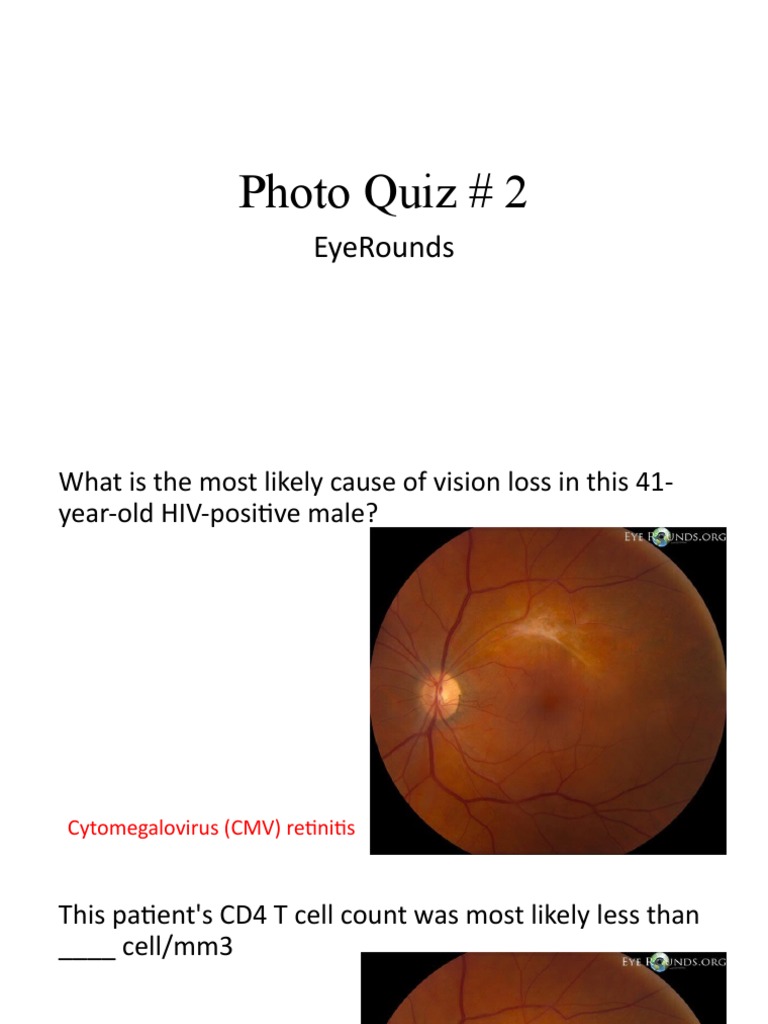 EyeRounds Photo Quiz 3 Cytomegalovirus Retinitis PDF