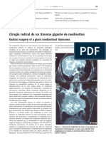 Cirugı A Radical de Un Timoma Gigante de Mediastino