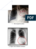 Broncograma Aéreo