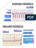 Fibrilación ventricular: ritmo irregular, onda P ausente