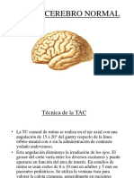 Tac de Cerebro Normal