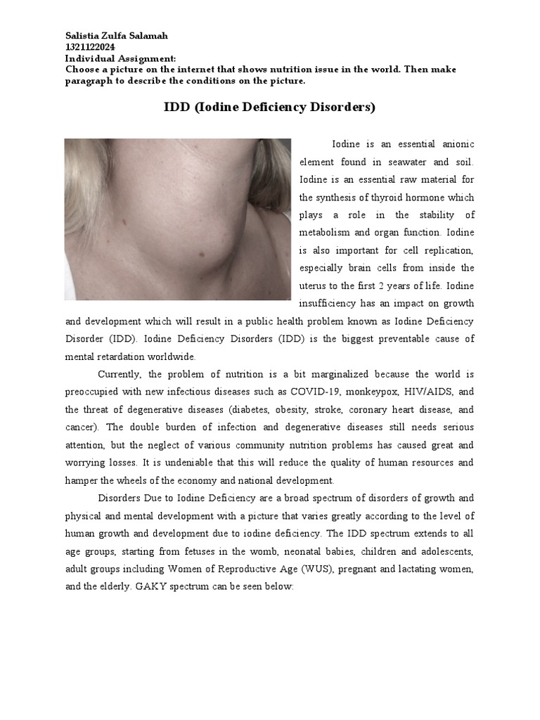 Individual Assigment IDD | PDF | Hypothyroidism | Salt