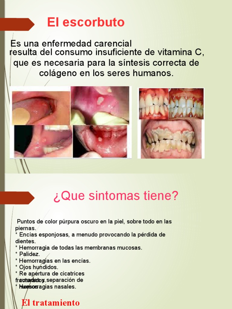 los-s-ntomas-y-tratamiento-del-escorbuto-una-enfermedad-por