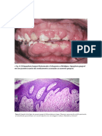 Hiperplasia gengival por medicamentos