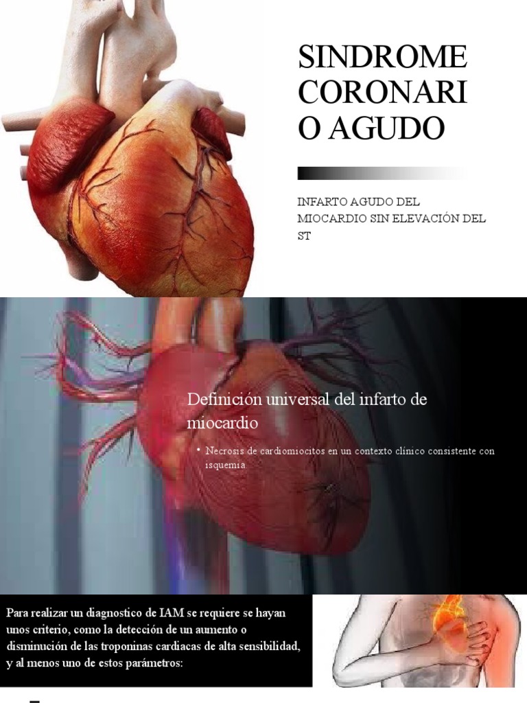 Iam Sest | PDF | Infarto de miocardio | Ciencias de la Salud