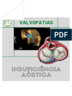 Valvopatias: Insuficiência Aórtica