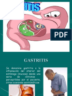 GASTRITIS