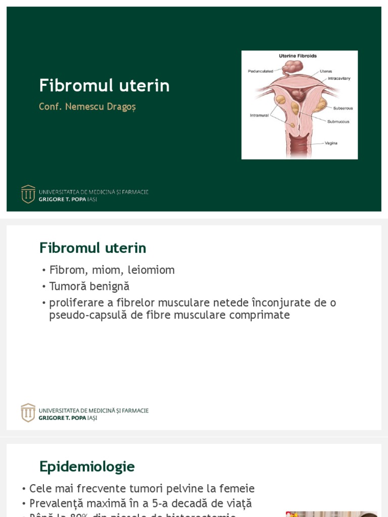Fibrom - Uterin - 2019 - Nemescu | PDF