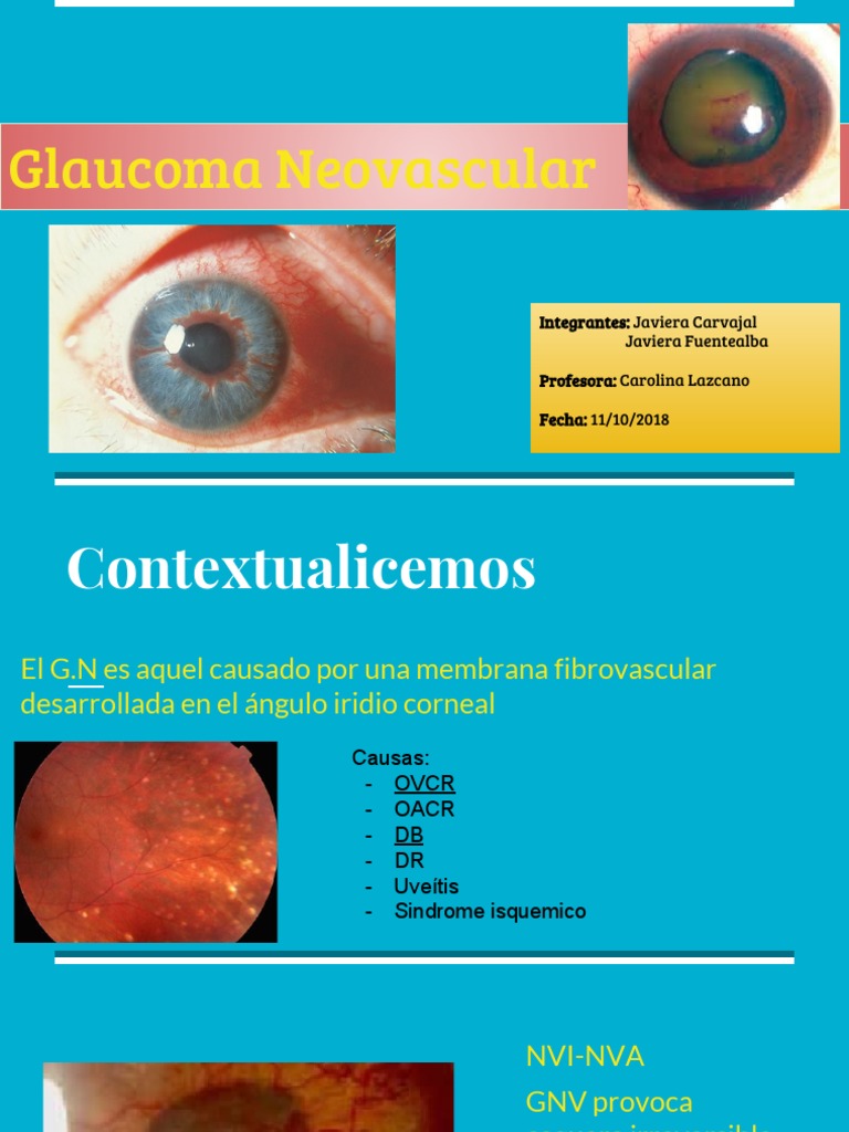 Glaucoma Neovascular: Causas y Tratamientos | PDF | Glaucoma | Sistema ...