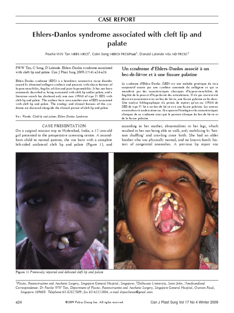 Ehlers Danlos Syndrome associated with cleft lip and palate PDF