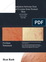 Differentiation Between Heat Rash and Eczema From Normal Skin